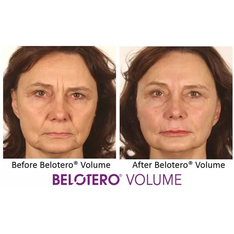 Belotero® Volume with Lidocaine
