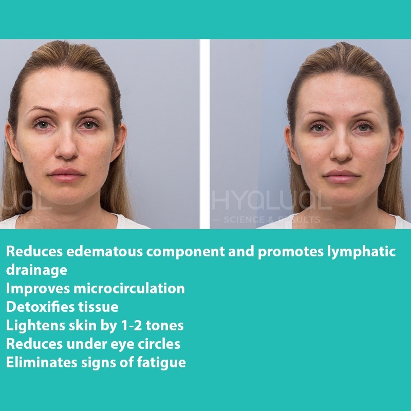 HYALUAL Xela Rederm 1.1