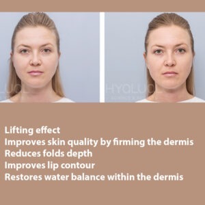 HYALUAL Xela Rederm 2.2