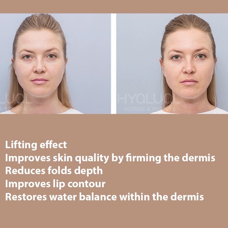 HYALUAL Xela Rederm 2.2