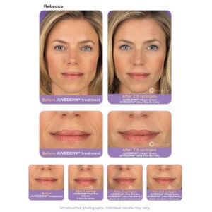 Juvederm® Ultra 2 with Lidocaine