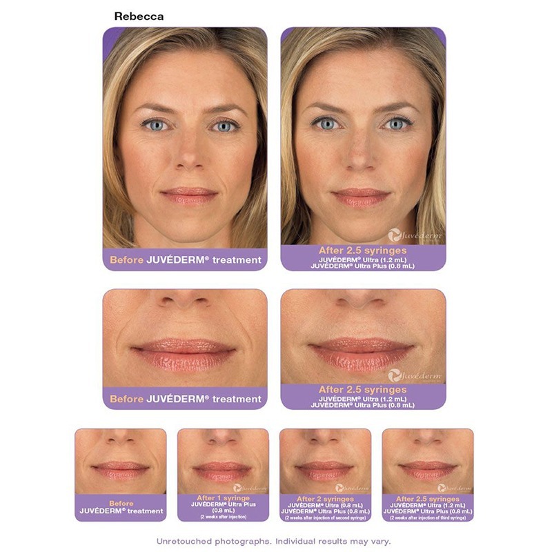 Juvederm® Ultra 2 with Lidocaine