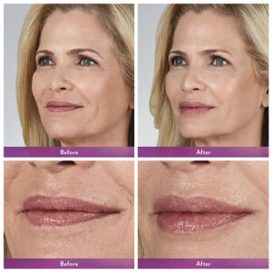 Juvederm ® Ultra 3 with Lidocaine Juvederm ® Ultra 3 with Lidocaine