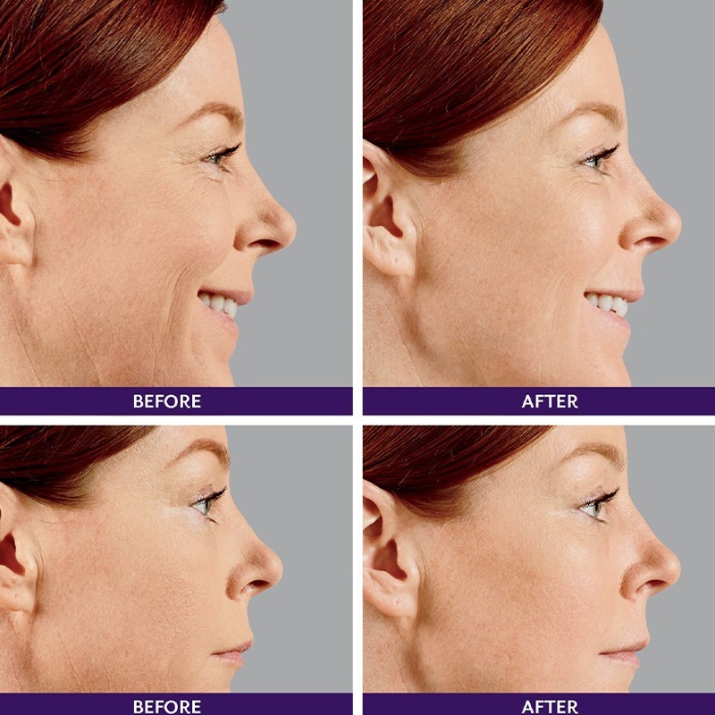 Juvederm ® Ultra 4 with Lidocaine