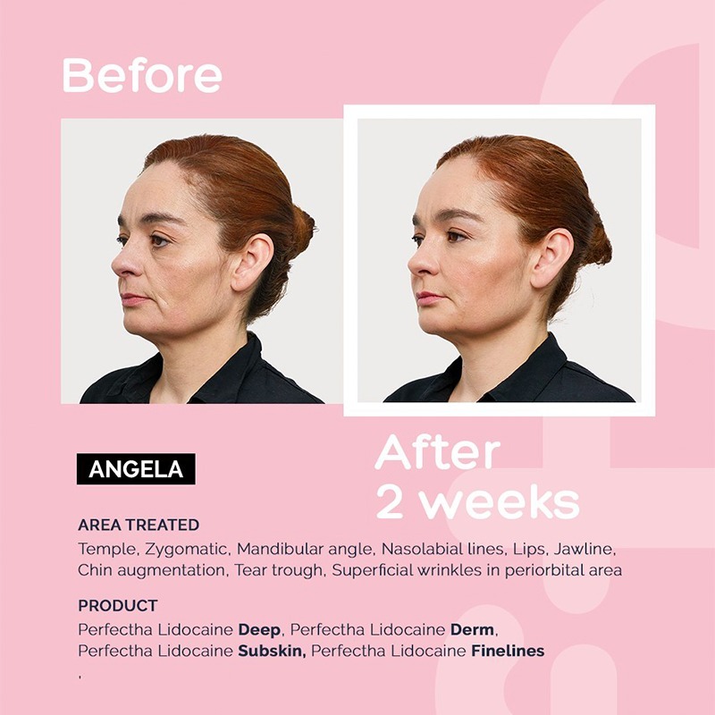 Perfectha Deep without lidocaine Perfectha Deep without lidocaine