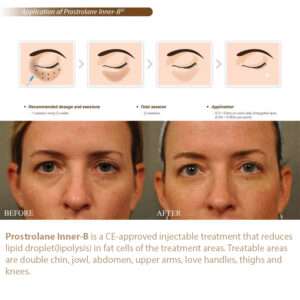 Prostrolane Inner B SE Prostrolane Inner B SE