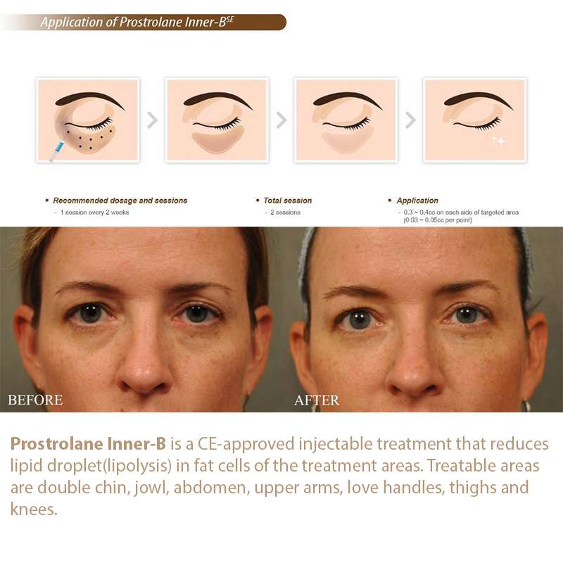 Prostrolane Inner B SE Prostrolane Inner B SE