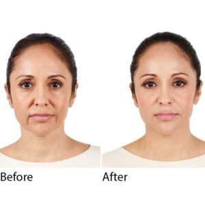 Radiesse Lifting & Volume Filler Radiesse Lifting & Volume Filler