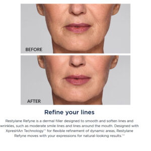 Restylane® Refyne Lidocaine