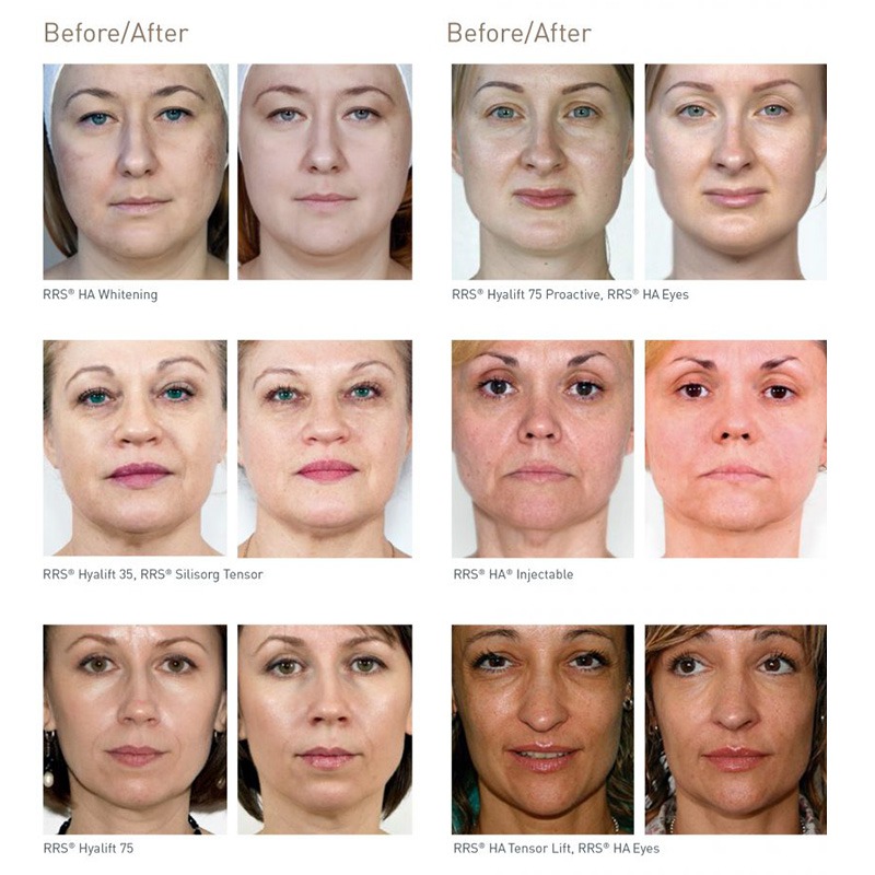 RRS® HA EYES RRS® HA EYES