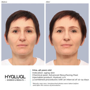 HYALUAL Advanced Resurfacing Peel