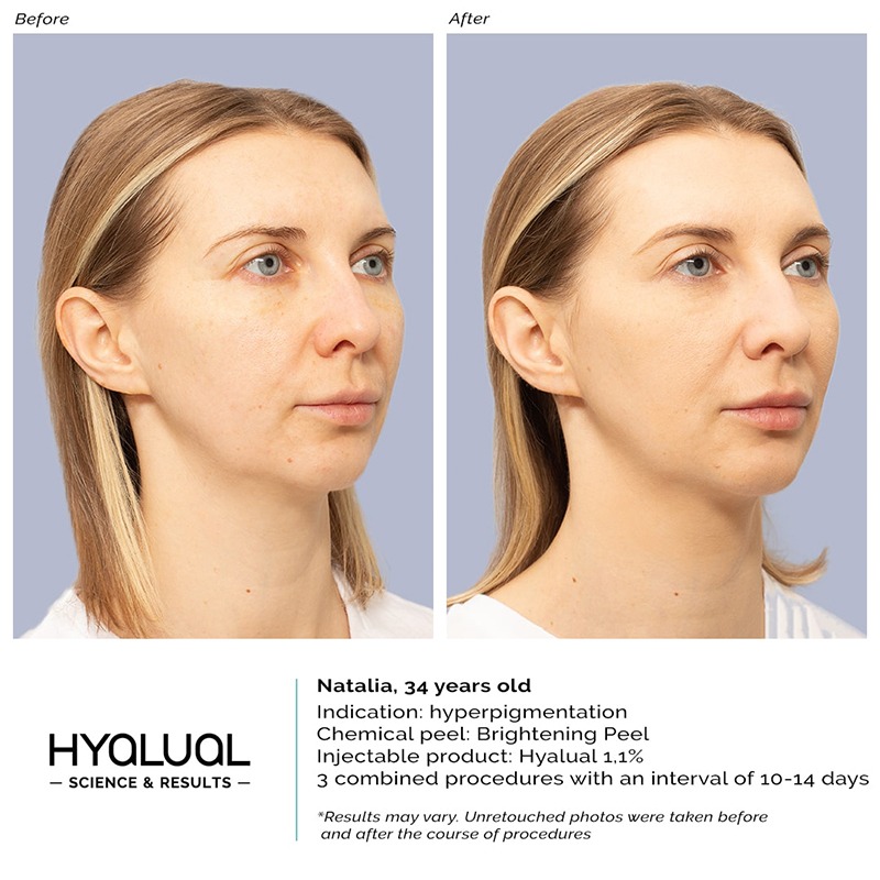 HYALUAL Brightening Peel