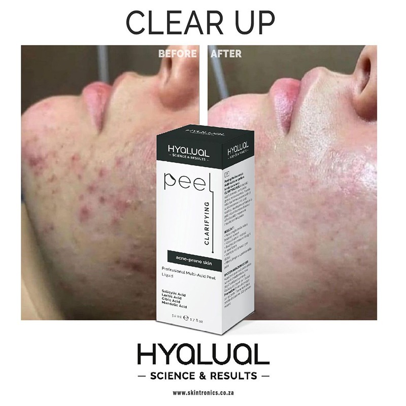 HYALUAL Clarifying Peel HYALUAL Clarifying Peel