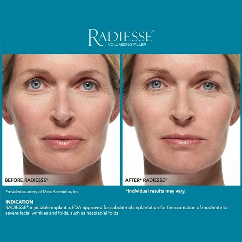 Radiesse with Lidocaine – Lifting & Volume Filler Radiesse with Lidocaine – Lifting & Volume Filler