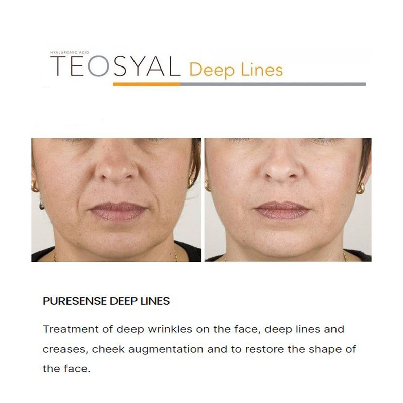 Teoxane Puresense Deeplines Teoxane Puresense Deeplines