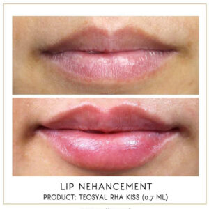 Teoxane RHA Kiss Teoxane RHA Kiss