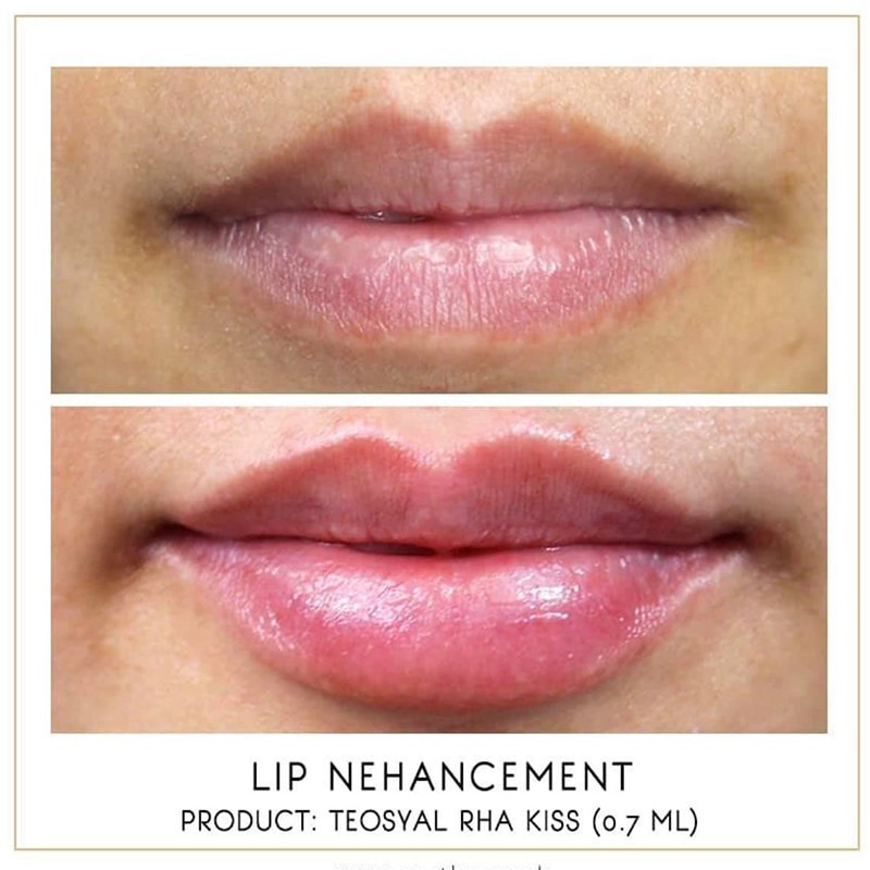 Teoxane RHA Kiss Teoxane RHA Kiss