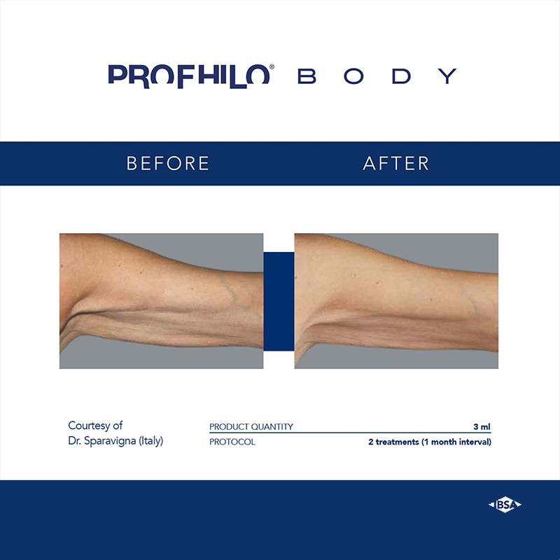 Profhilo Body Profhilo Body