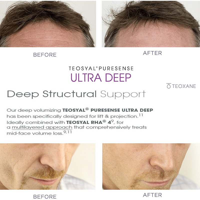 Teoxane Puresense Ultra Deep