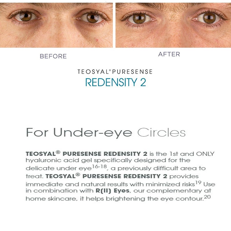 Teoxane Teosyal Redensity 2 Teoxane Teosyal Redensity 2