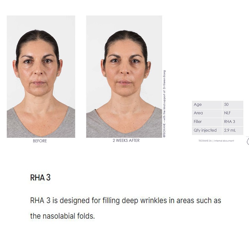 Teoxane Teosyal RHA 3 Teoxane Teosyal RHA 3