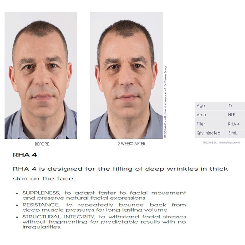 Teoxane Teosyal RHA 4 Teoxane Teosyal RHA 4