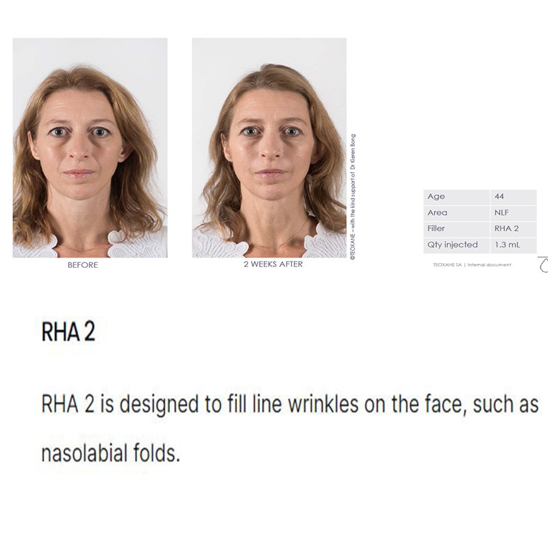 Teoxane Teosyal RHA 2 Teoxane Teosyal RHA 2